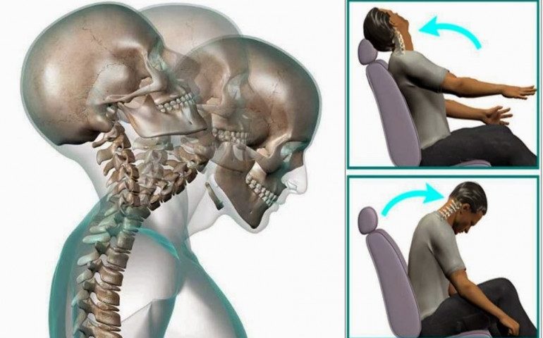 indemnizaciones esguince latigazo cervicalgia