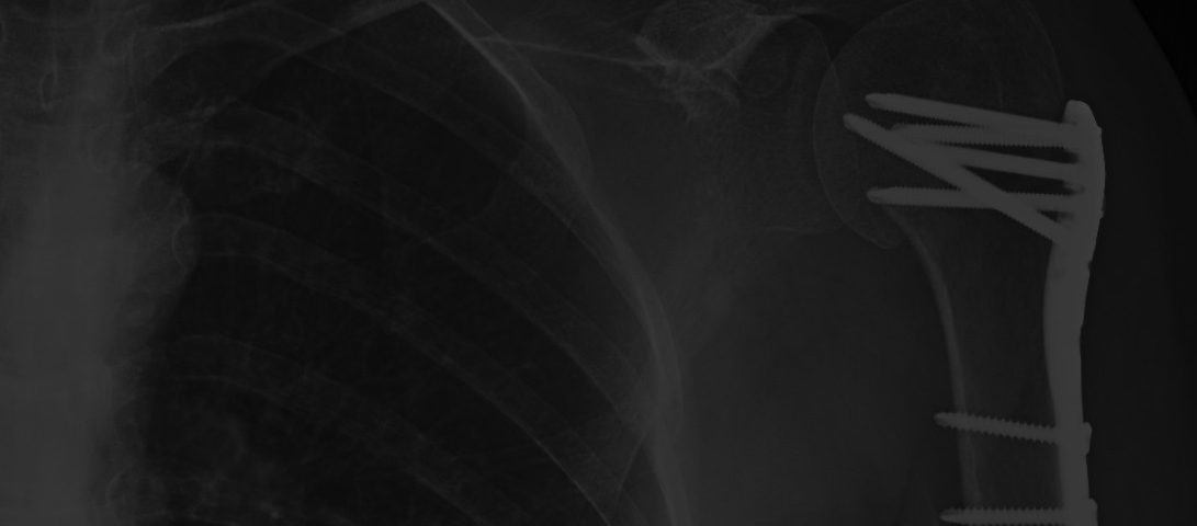 Indemnizacion Fractura De Humero Hombro Luxacion